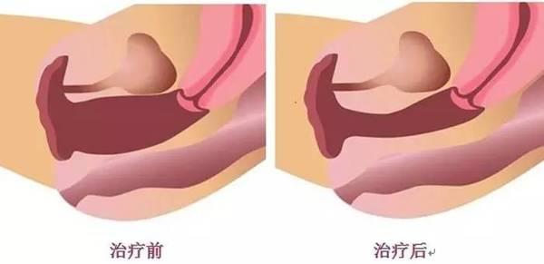 女性阴道松弛是哪些原因造成的