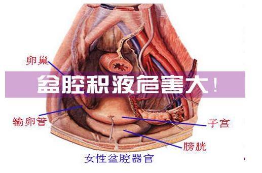 盆腔积液危害大