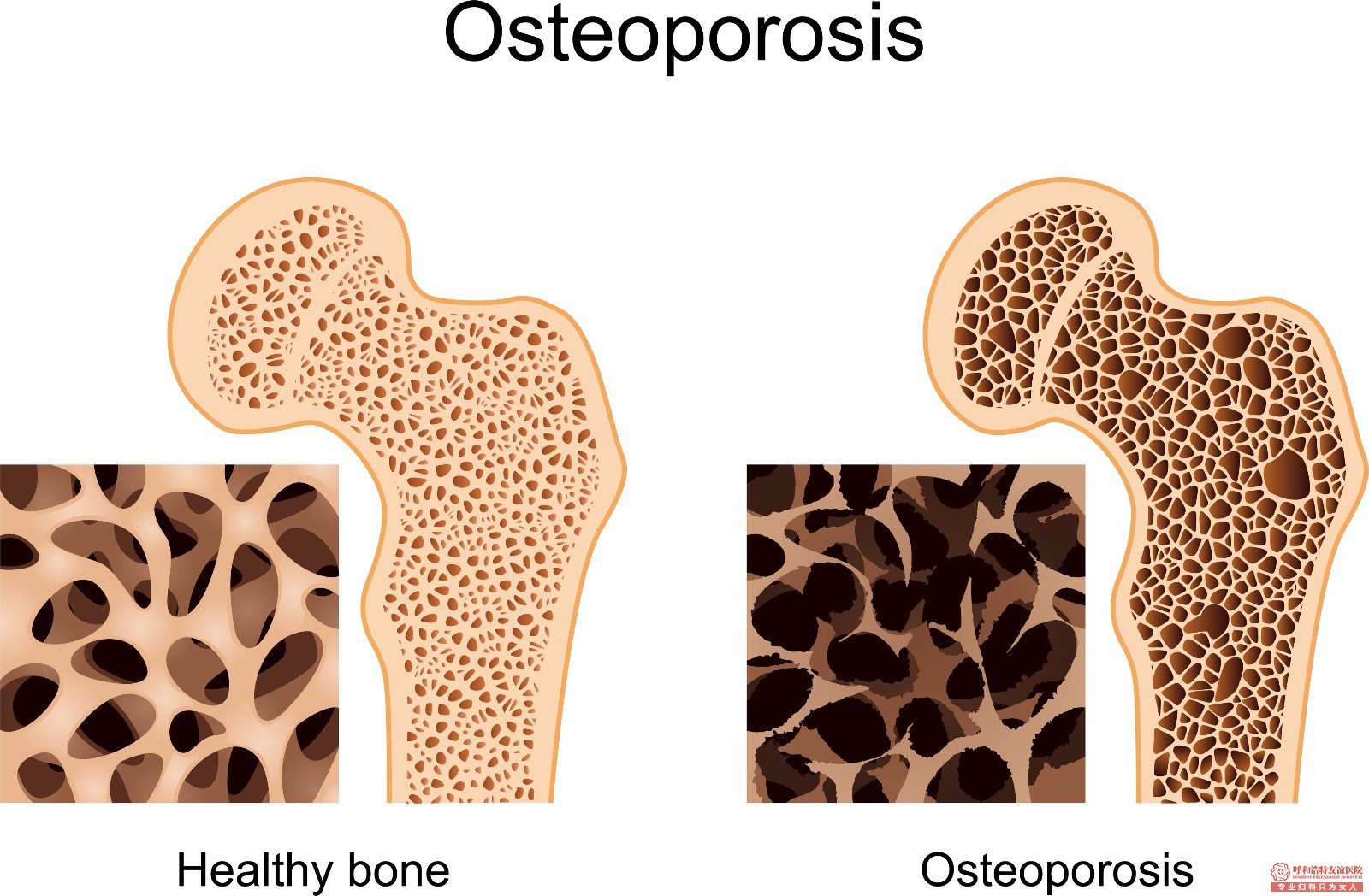 osterporosis.jpg