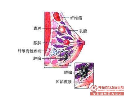 乳腺肿瘤不治疗有什么危害