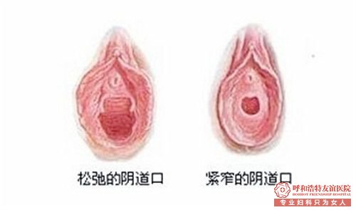 阴道紧缩术的注意事项