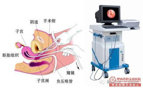 金华超导可视无痛人流术安全性高吗